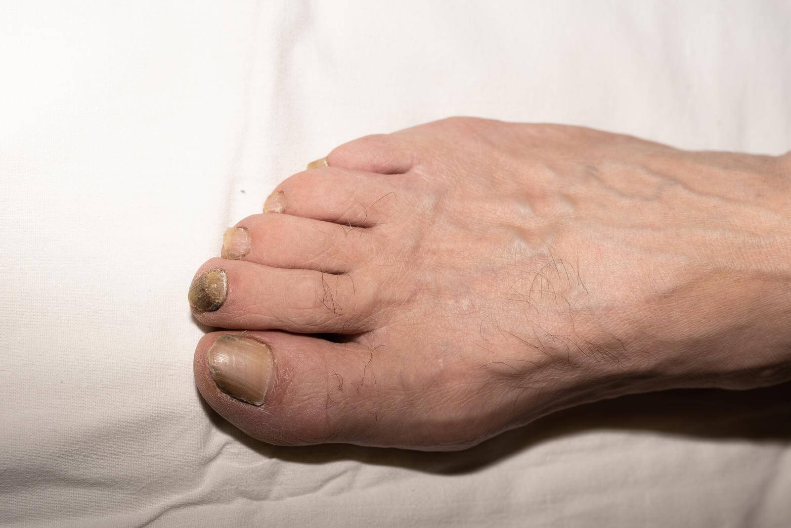 The nails on the right foot of a man of retirement age are delaminated due to age, are affected by a yellow fungus.