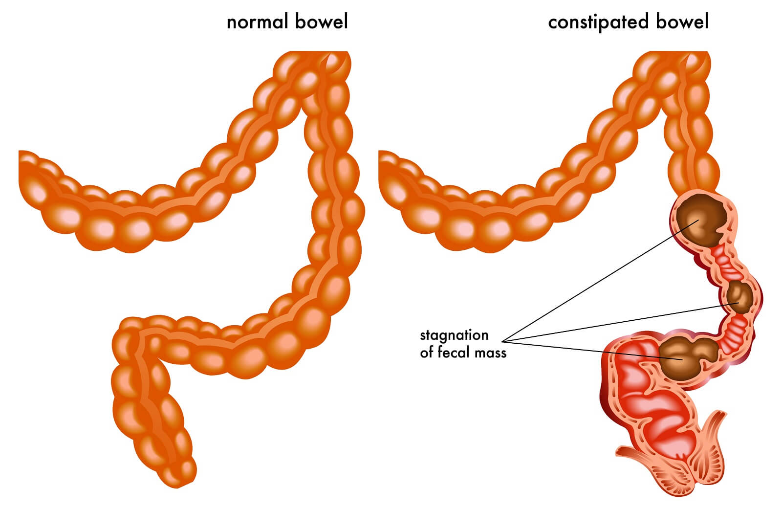 A diagram of a constipated intestine versus normal intestine.