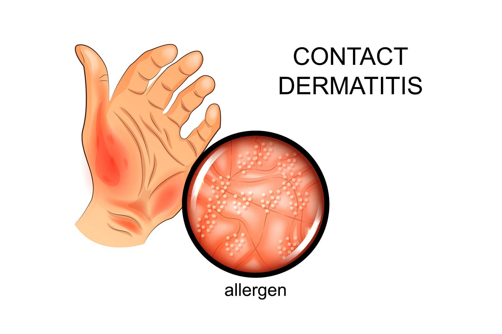 A graphical illustration of contact dermatitis.