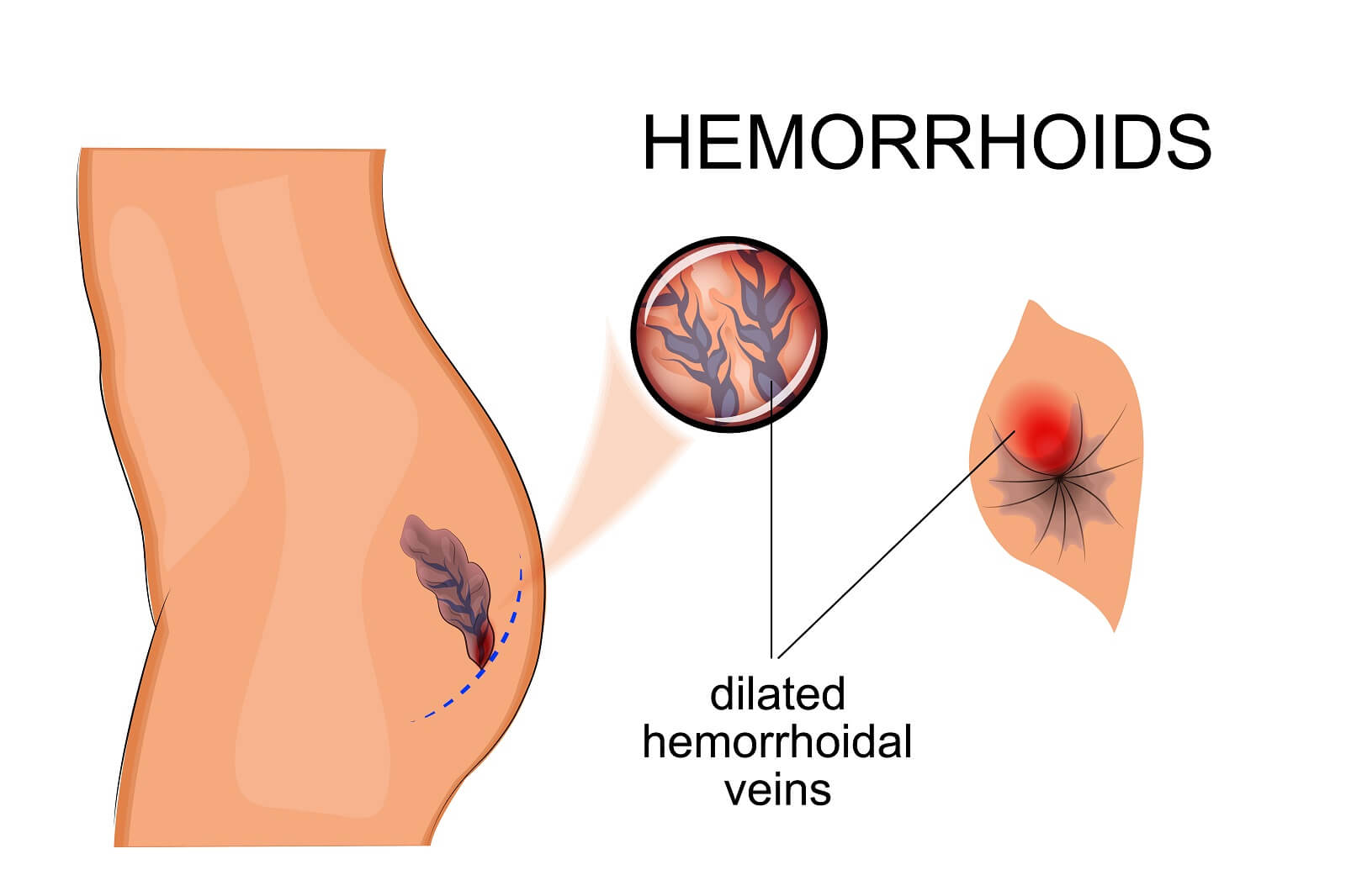 A graphical illustration of hemorrhoidal veins.