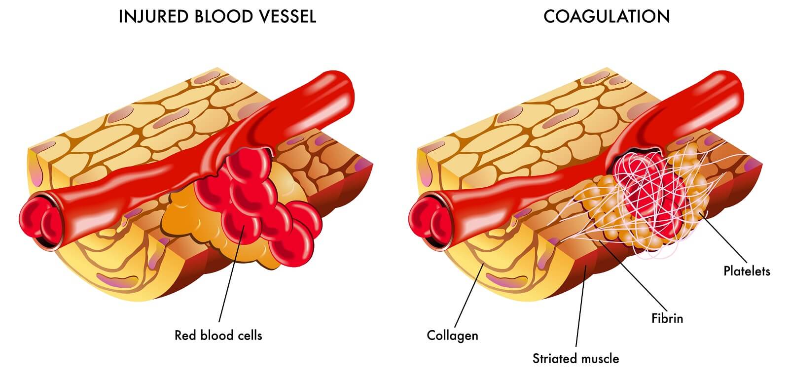 Diagram of injured blood vessel and fibrin assisting in blood coagulation.