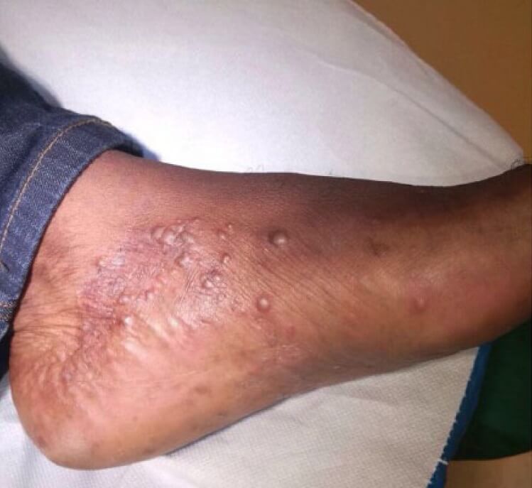 Candida albicans infection of the skin on a foot.