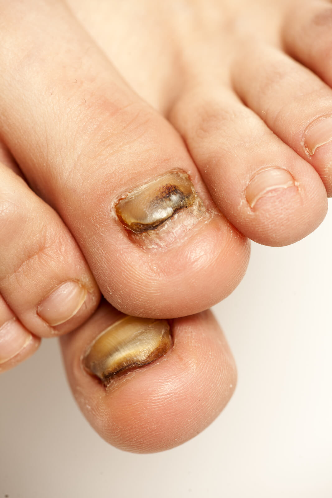 fungal infections of the nails of the feet (toenails) of a young woman.