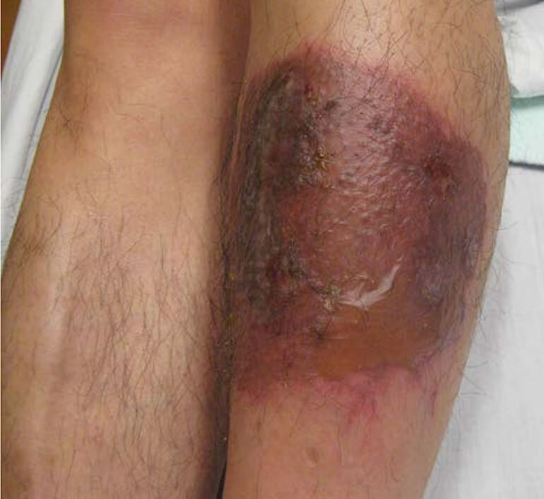 Tense blister (chemical burn) formation on anterior shin after application of topical garlic and salt paste.
