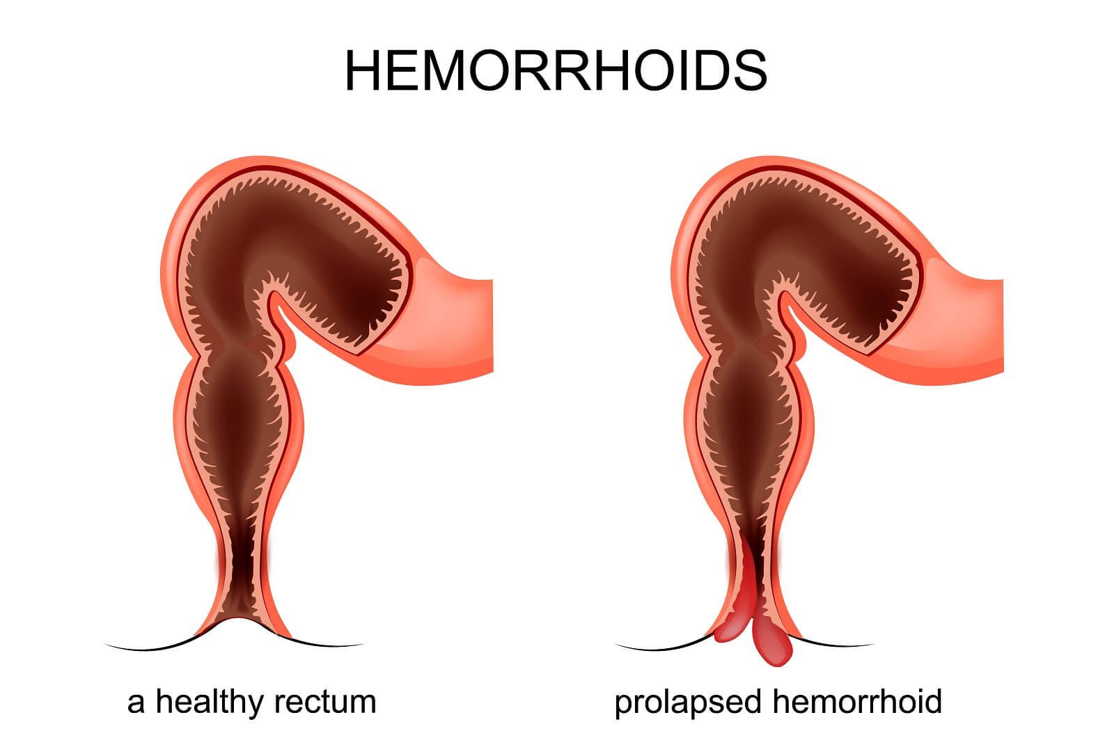 Prolapse of the hemorrhoidal veins — Illustration