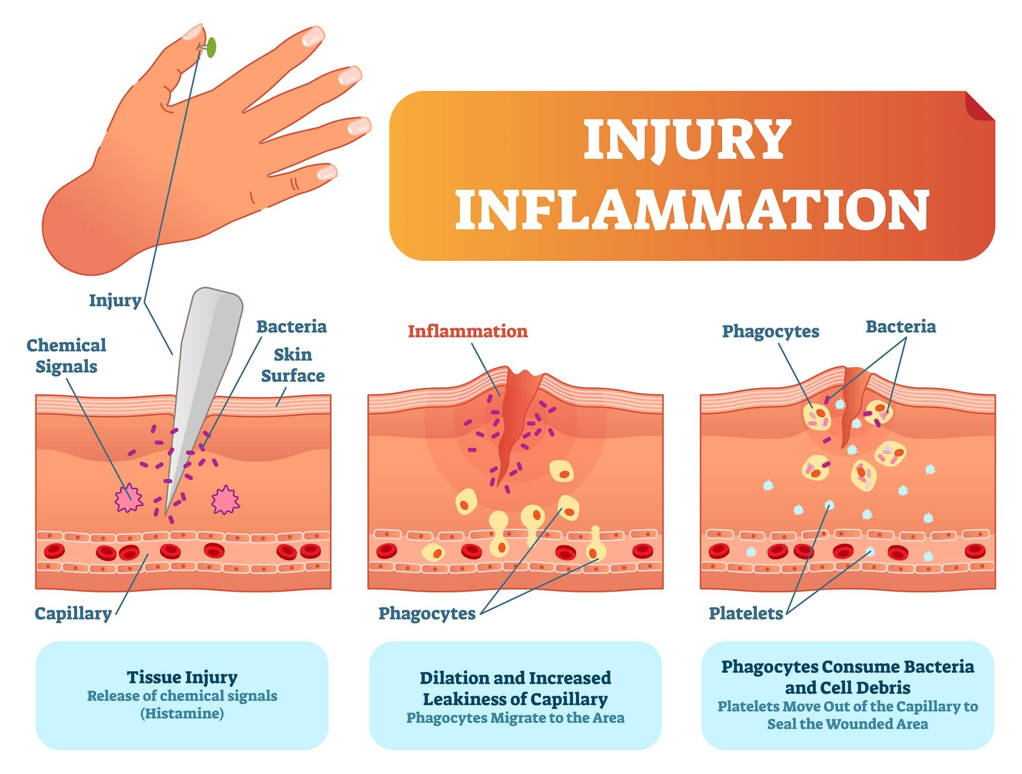 Injury inflammation biological response diagram. Skin surface injury cross section poster with capillary, phagocytes and platelets in diagram.