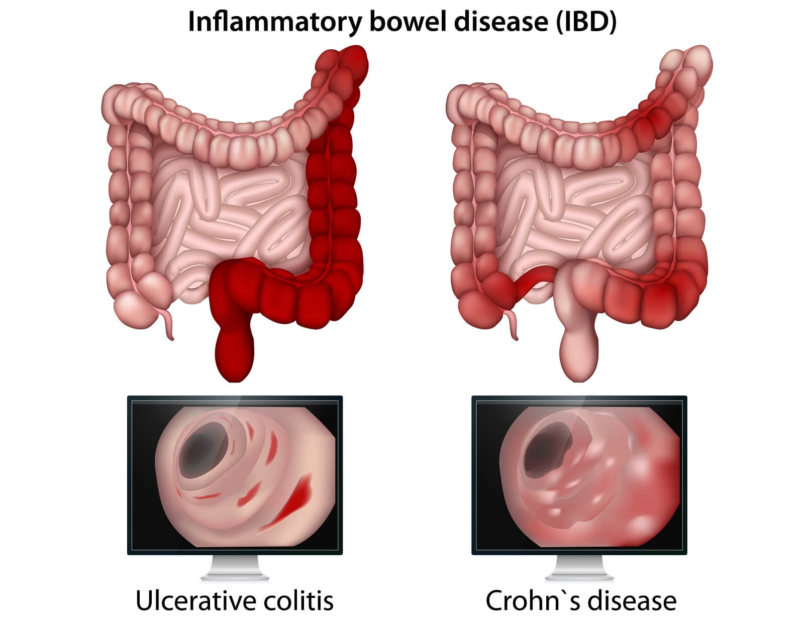 Inflammatory bowel disease medical vector illustration on white background.
