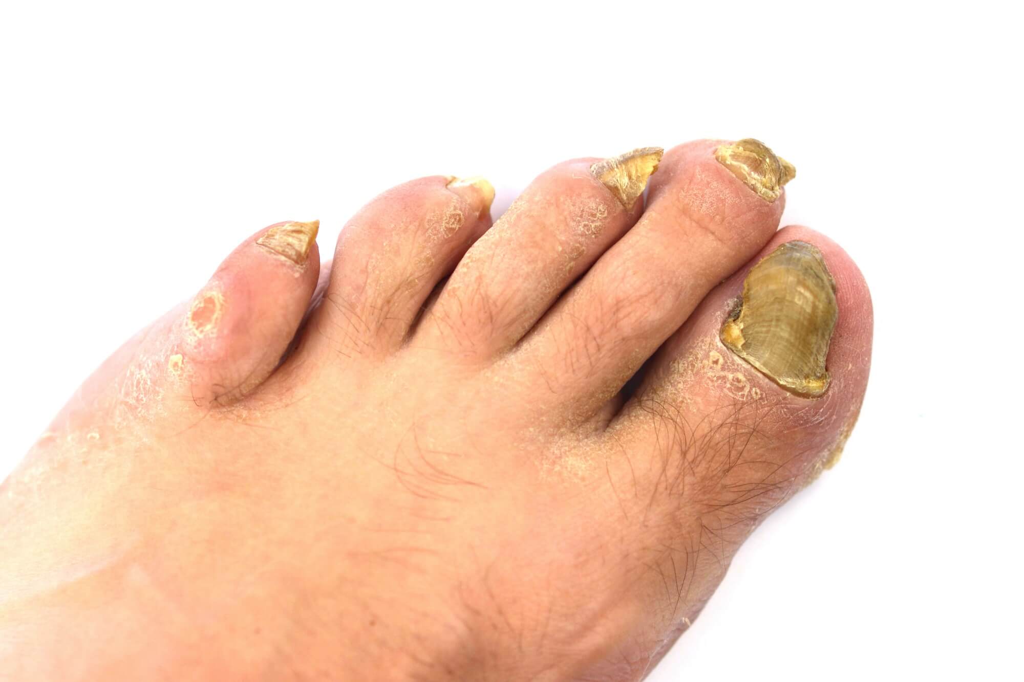 A picture of toenail fungus (onychomycosis)