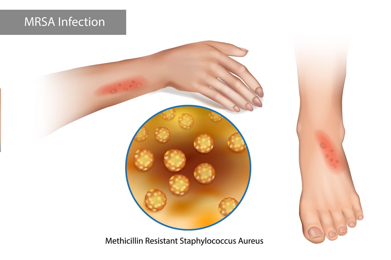 MRSA Infection. Methicillin Resistant Staphylococcus Aureus. Rashes on the arms and legs caused by staphylococcus — Vector