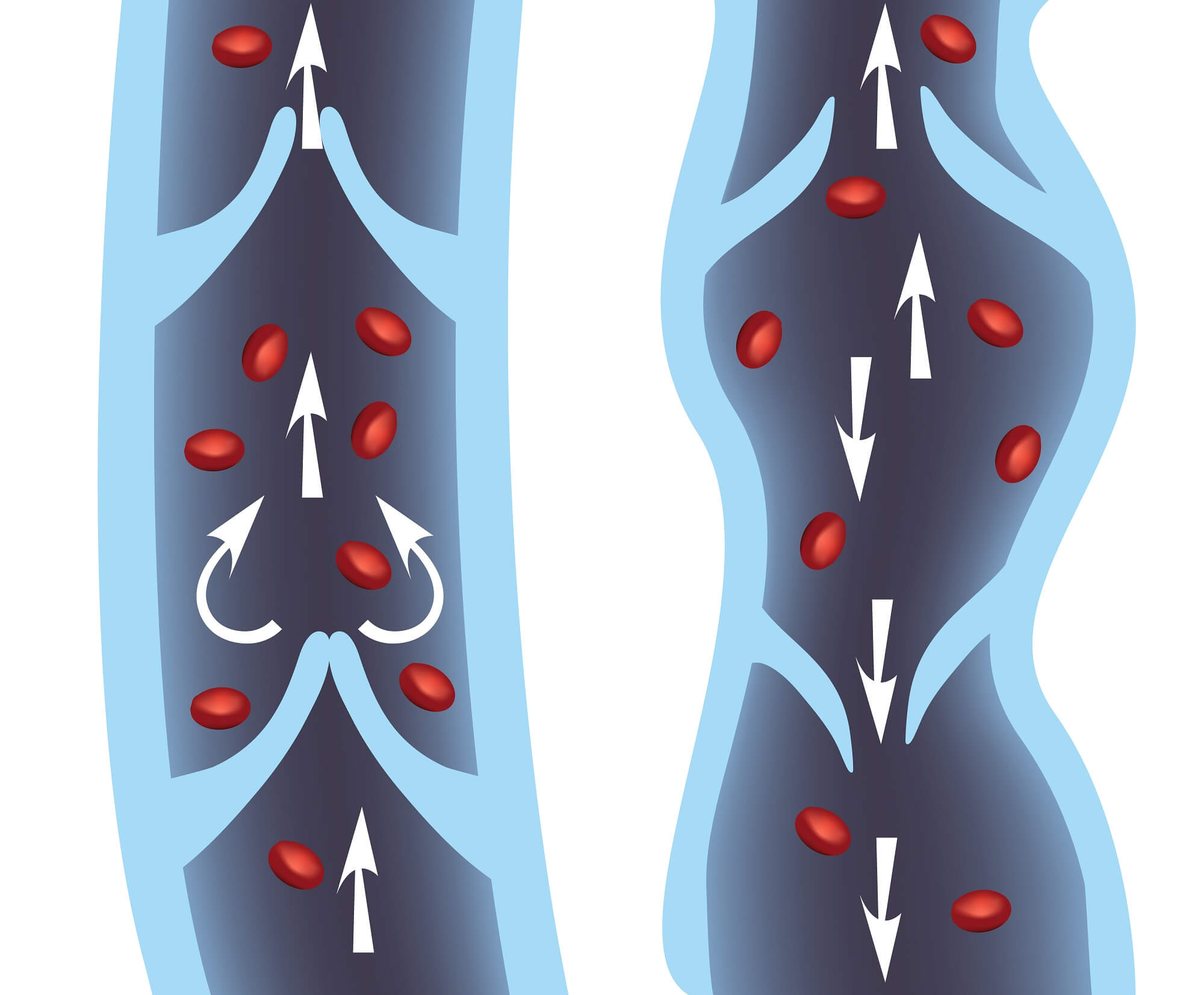 Diagram of normal vein and a Diagram of a varicose vein.