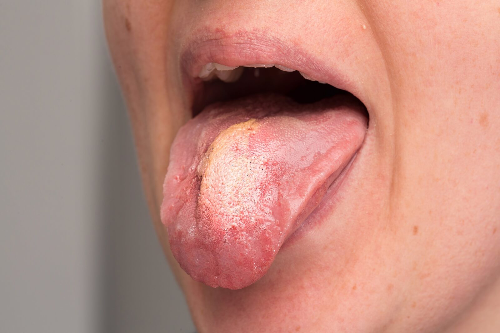 A woman sticking tongue out with oral thrush visible as a white plaque.
