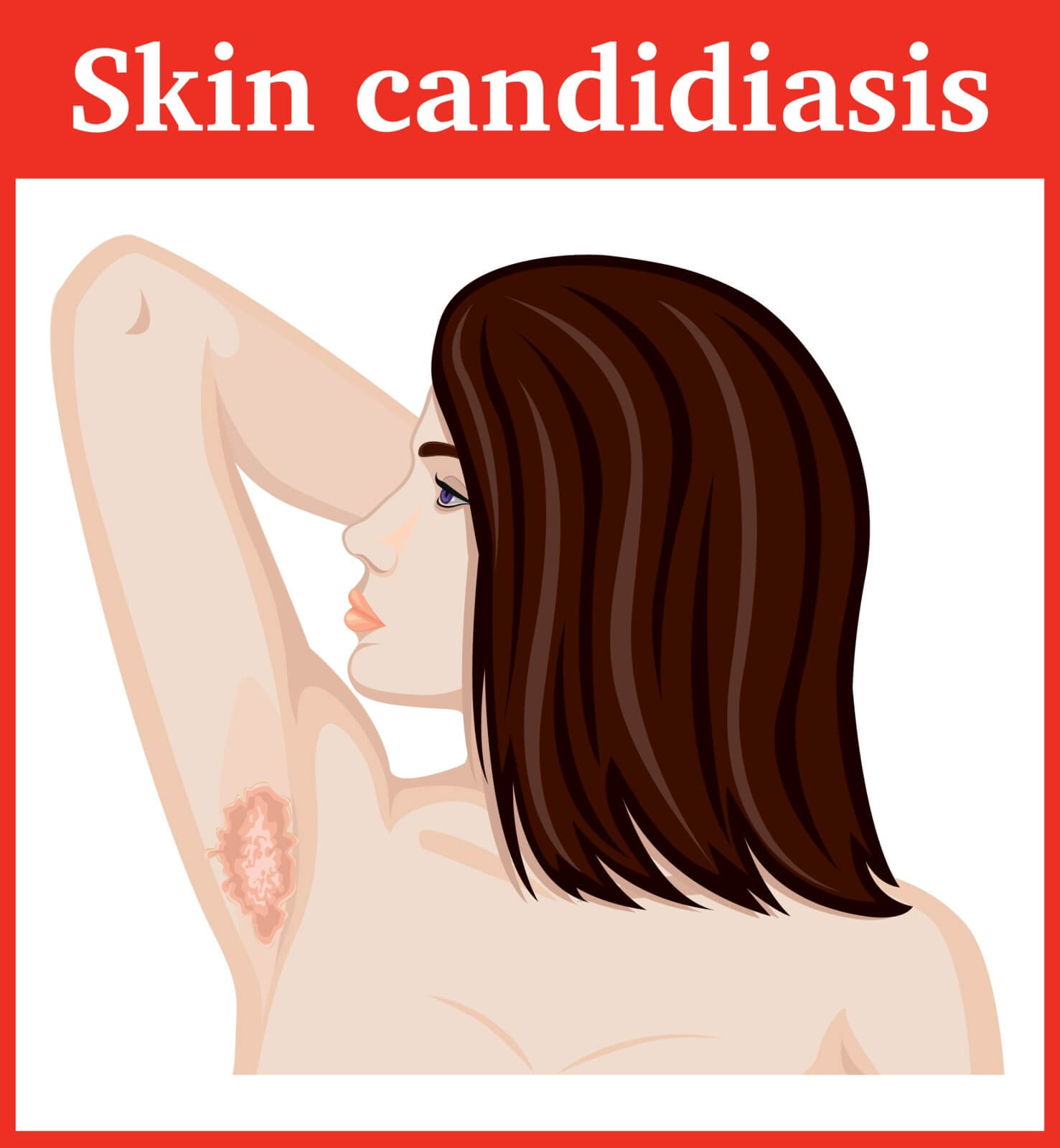 Skin Yeast Infection (Candidiasis) Illustration