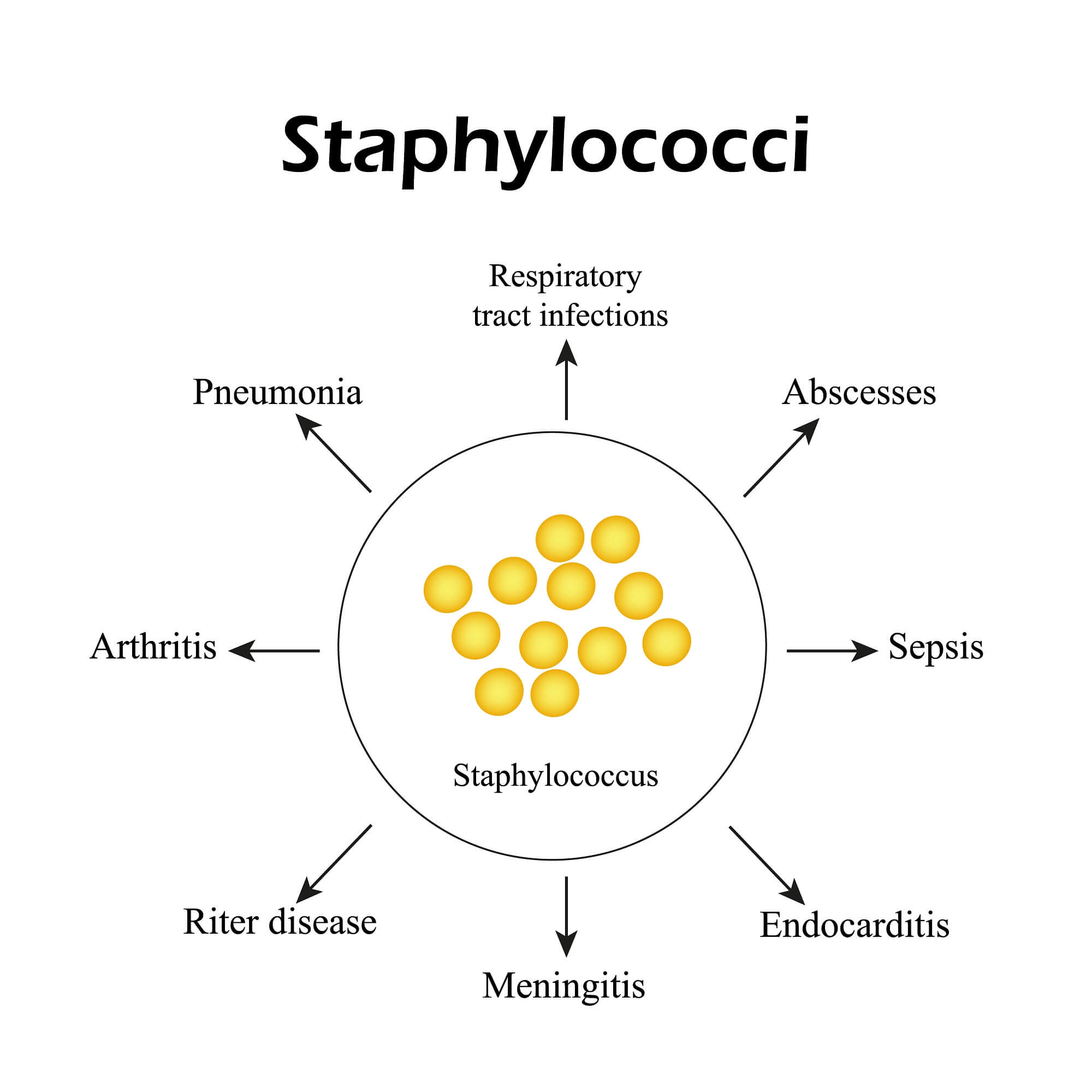 Staphylococci. Staphylococcus aureus diseases. Infographics. Vector illustration.