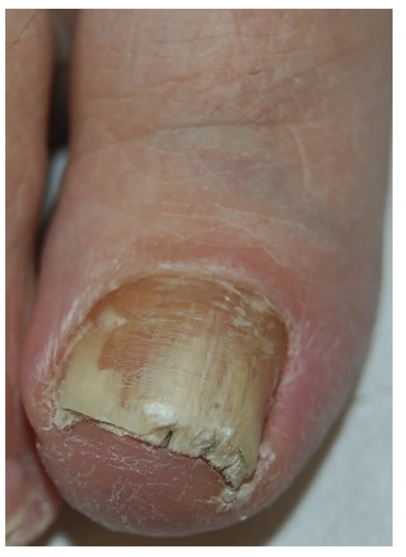 Distal and lateral subungual onychomycosis (DLSO): whitish discoloration, onycholysis and subungual hyperkeratosis.