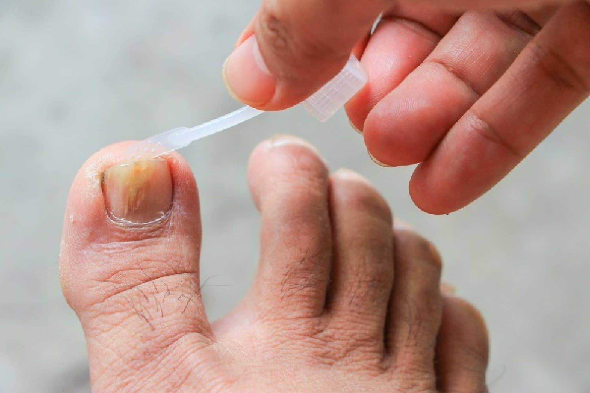 Pure allicin to treat toenail infections