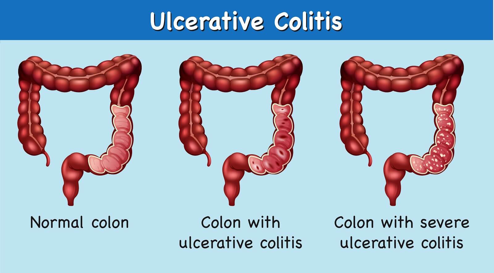 Diagram showing ulcerative colitis and severe ulcerative colitis.