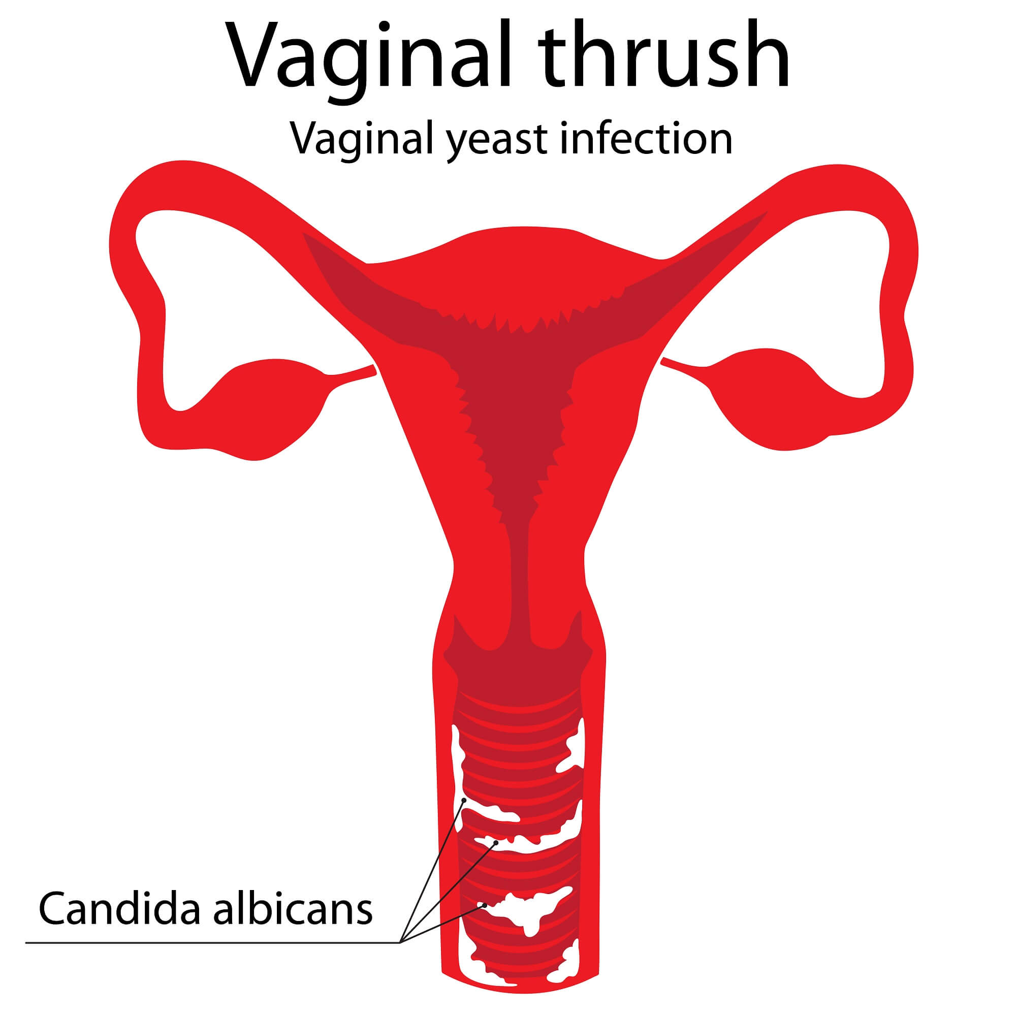Vagainal yeast infection (thrush) diagram with uterus and vaginal canal infected with Candida.