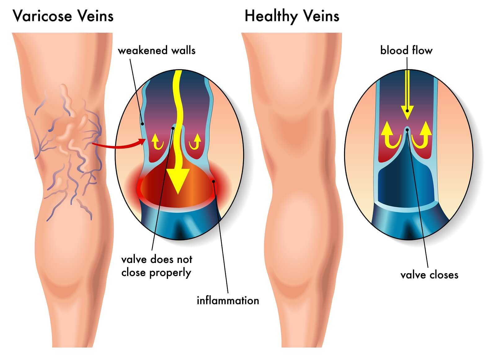 Diagram explaining varicose veins