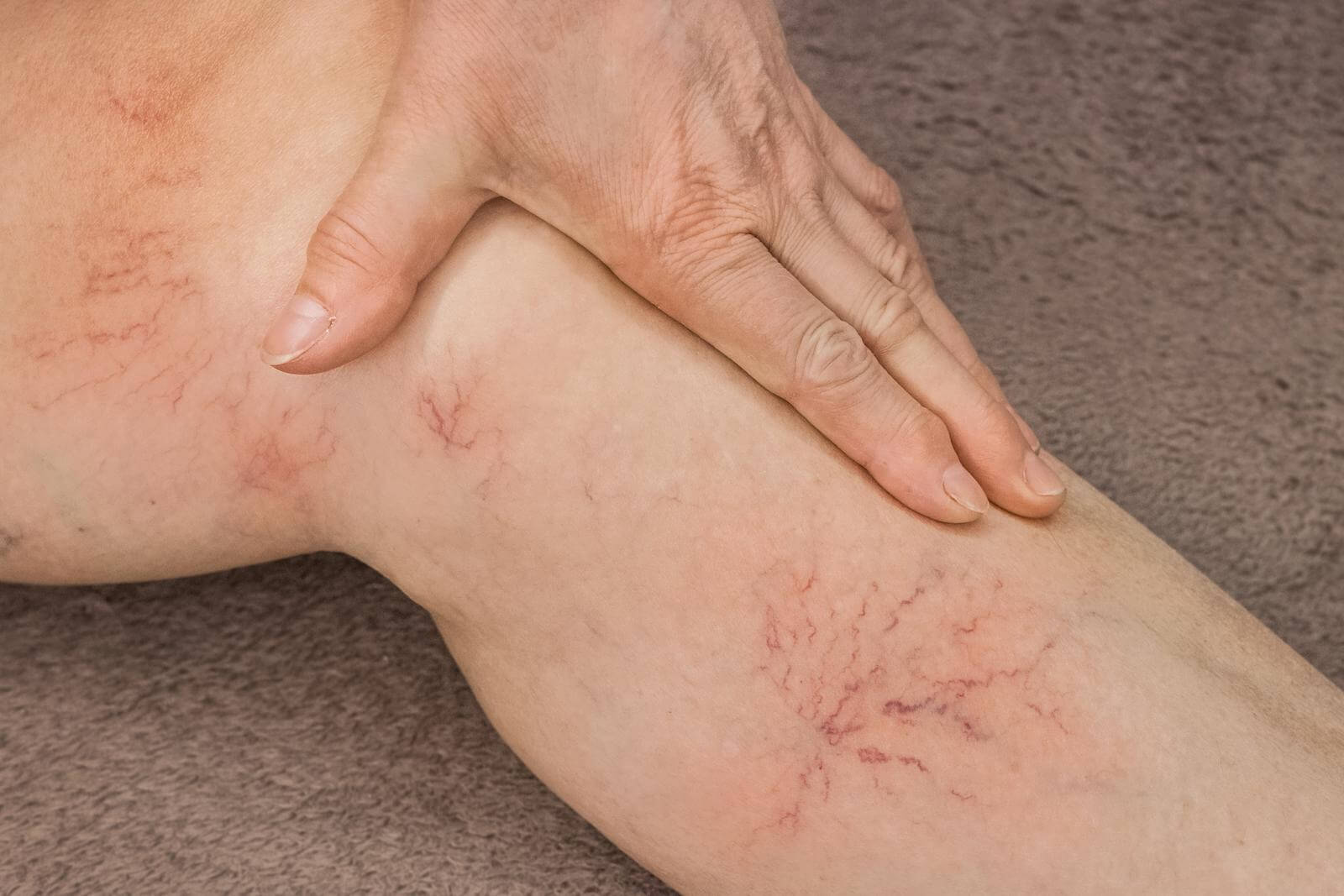 An elderly woman's hand touches her sick leg with vein thrombosis, varicose veins (spider veins).