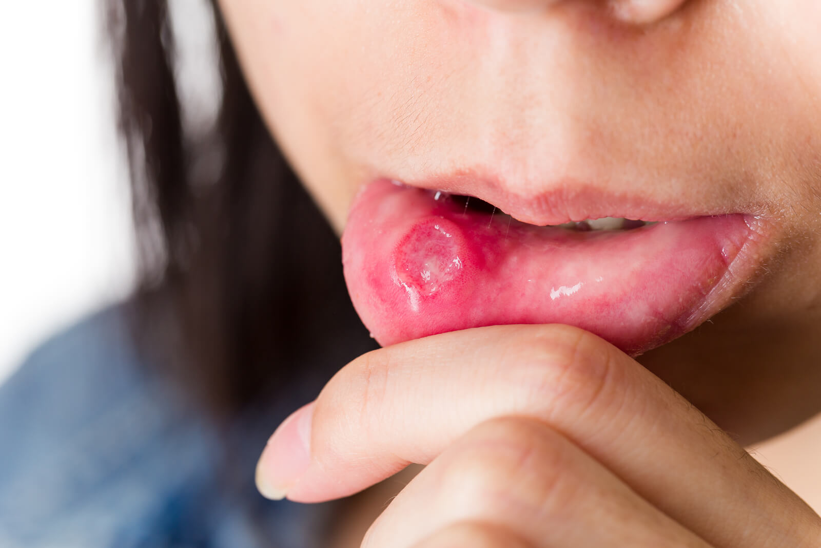 A woman with a canker sore (aphthous ulcer) on her inner lip.