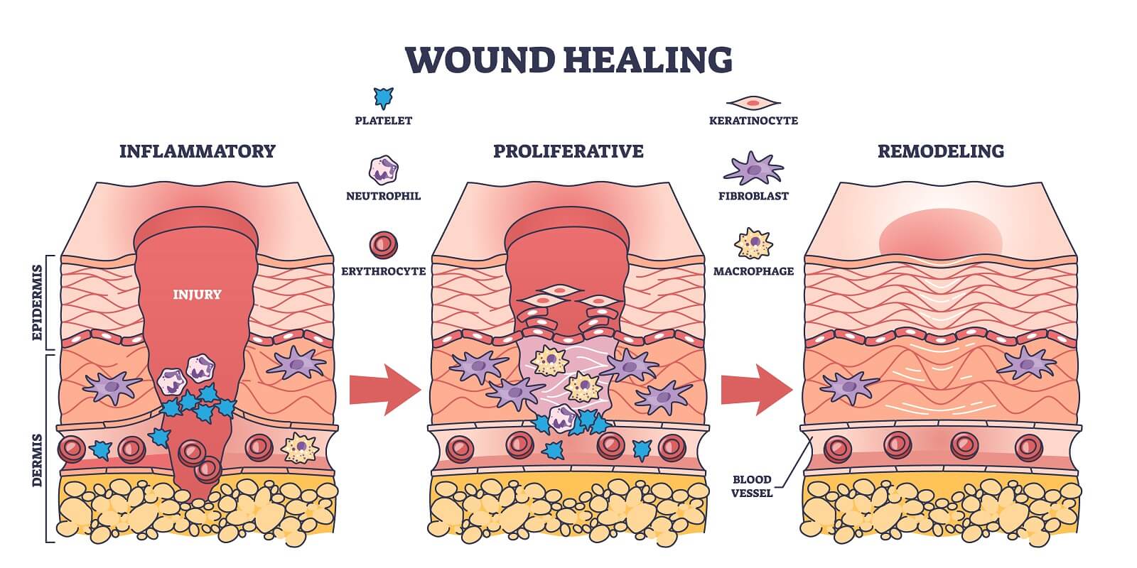 Process of wound healing and anatomical body injury repair outline diagram. Labeled educational scheme with medical epidermis skin inflammatory, proliferative, and remodeling stages.