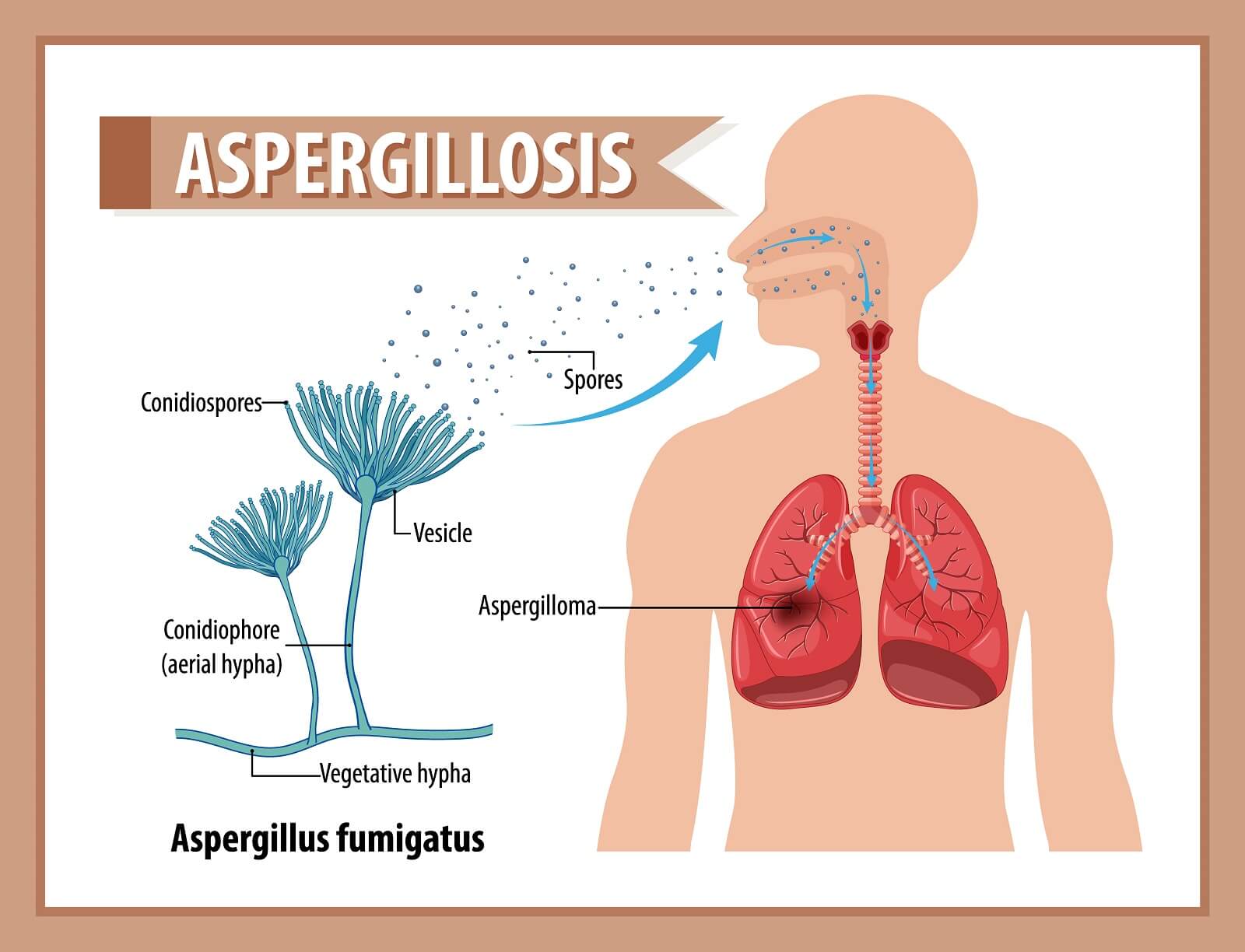 Diagram showing aspergillus infection illustration.